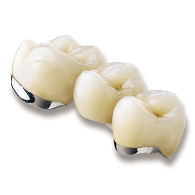 Металлокерамические коронки: преимущества, особенности и эстетика